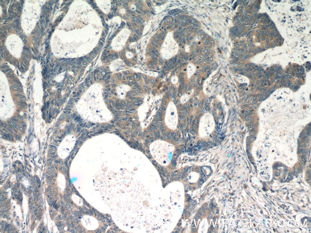 Immunohistochemistry (IHC) staining of human colon cancer tissue using RPS3 Polyclonal antibody (15198-1-AP)