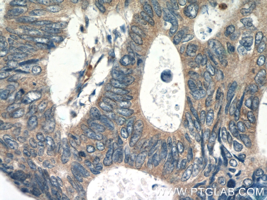 Immunohistochemistry (IHC) staining of human colon cancer tissue using RPS3 Polyclonal antibody (15198-1-AP)