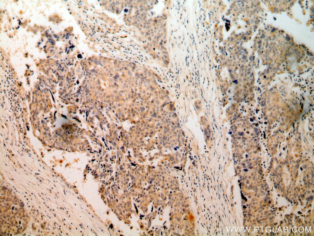 Immunohistochemistry (IHC) staining of human ovary tumor tissue using RPS3 Polyclonal antibody (15198-1-AP)