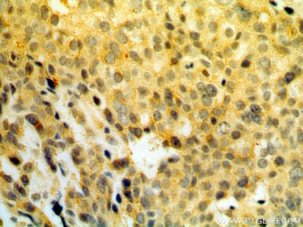 Immunohistochemistry (IHC) staining of human ovary tumor tissue using RPS3 Polyclonal antibody (15198-1-AP)