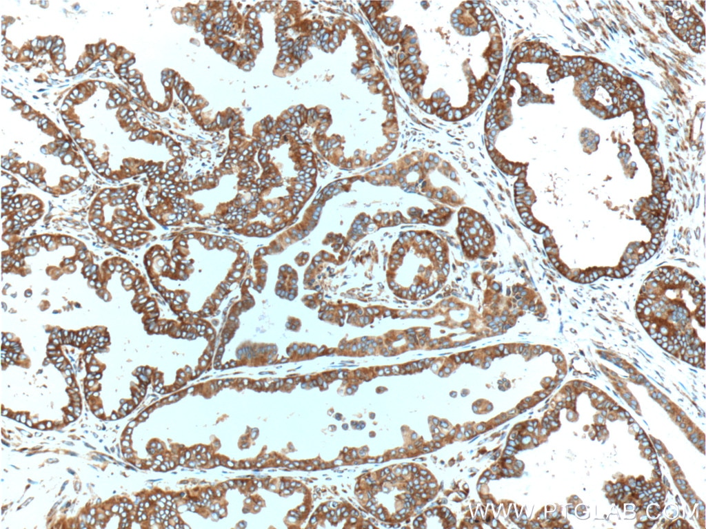 Immunohistochemistry (IHC) staining of human ovary tumor tissue using RPS3 Monoclonal antibody (66046-1-Ig)