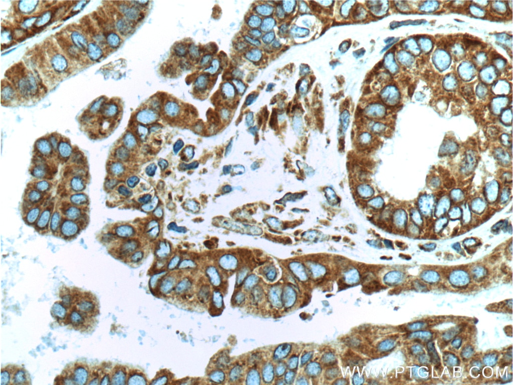 Immunohistochemistry (IHC) staining of human ovary tumor tissue using RPS3 Monoclonal antibody (66046-1-Ig)