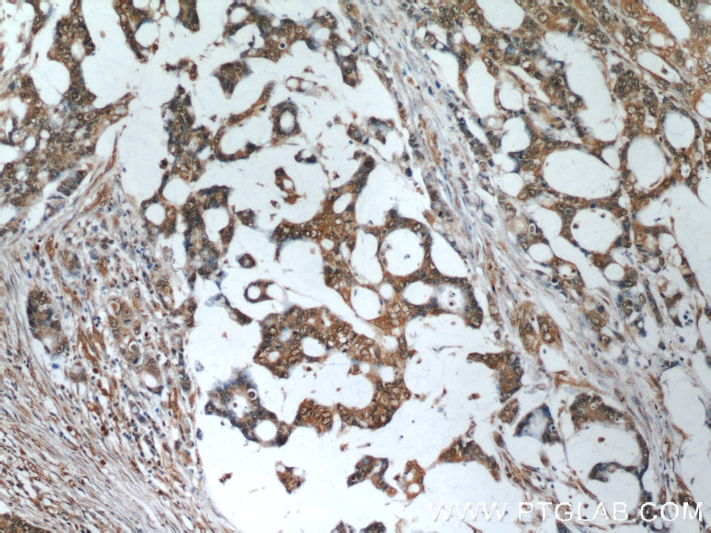 Immunohistochemistry (IHC) staining of human colon cancer tissue using RPS3 Monoclonal antibody (66046-1-Ig)
