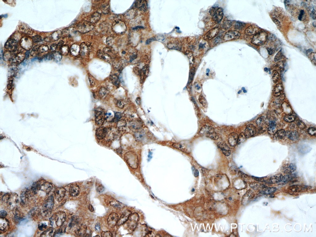 Immunohistochemistry (IHC) staining of human colon cancer tissue using RPS3 Monoclonal antibody (66046-1-Ig)