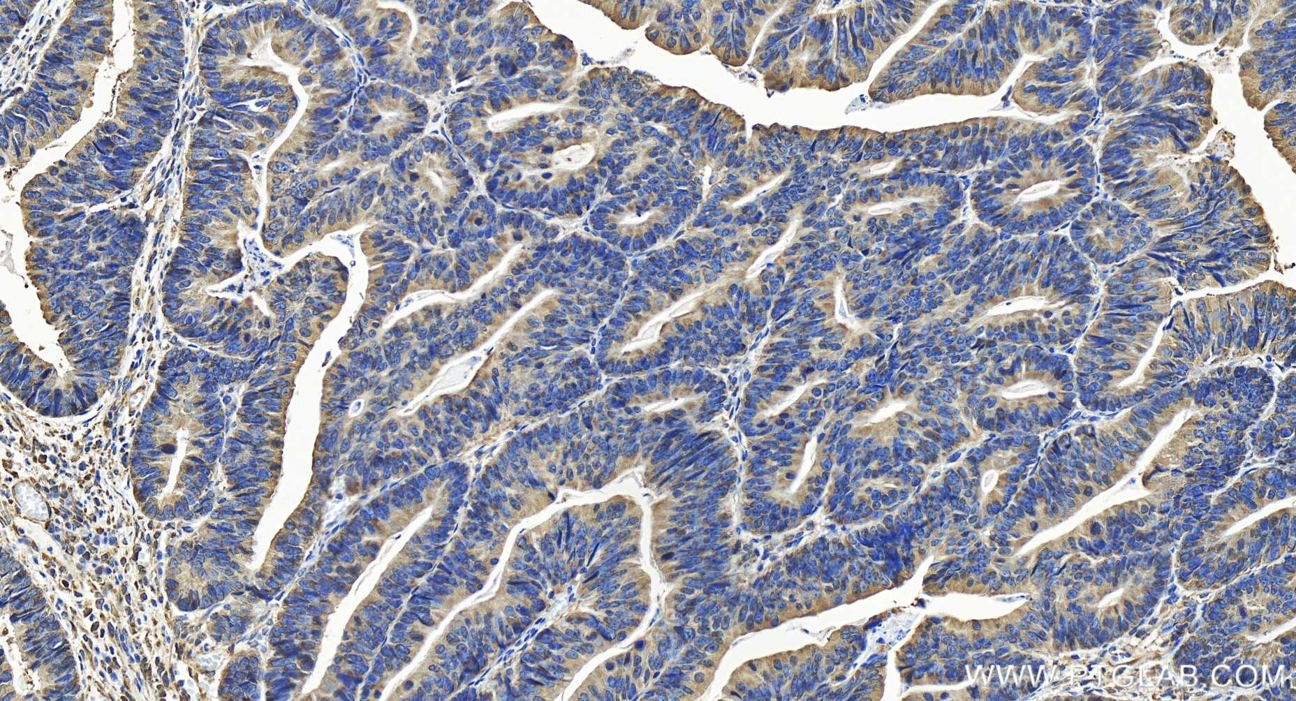 Immunohistochemistry (IHC) staining of human colon cancer tissue using RPS3 Recombinant antibody (84947-4-RR)