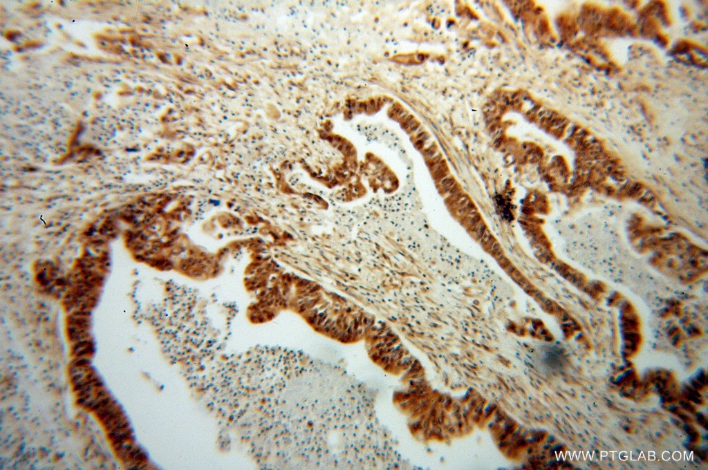 Immunohistochemistry (IHC) staining of human pancreas cancer tissue using RPS3A Polyclonal antibody (14123-1-AP)