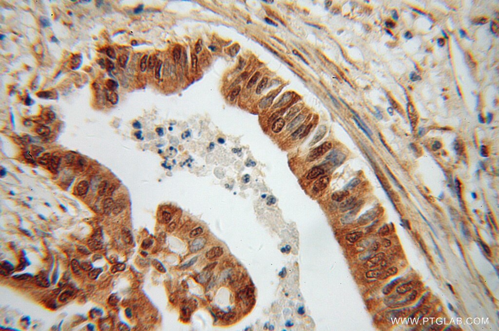 Immunohistochemistry (IHC) staining of human pancreas cancer tissue using RPS3A Polyclonal antibody (14123-1-AP)