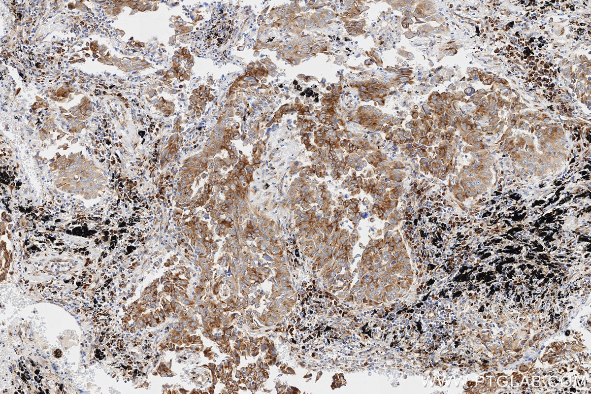 IHC staining of Human lung cancer (Adenocarcinoma) using 86254-3-RR Immunohistochemistry (IHC) staining of Human lung cancer (Adenocarcinoma) using RPS3A Recombinant monoclonal antibody (86254-3-RR)