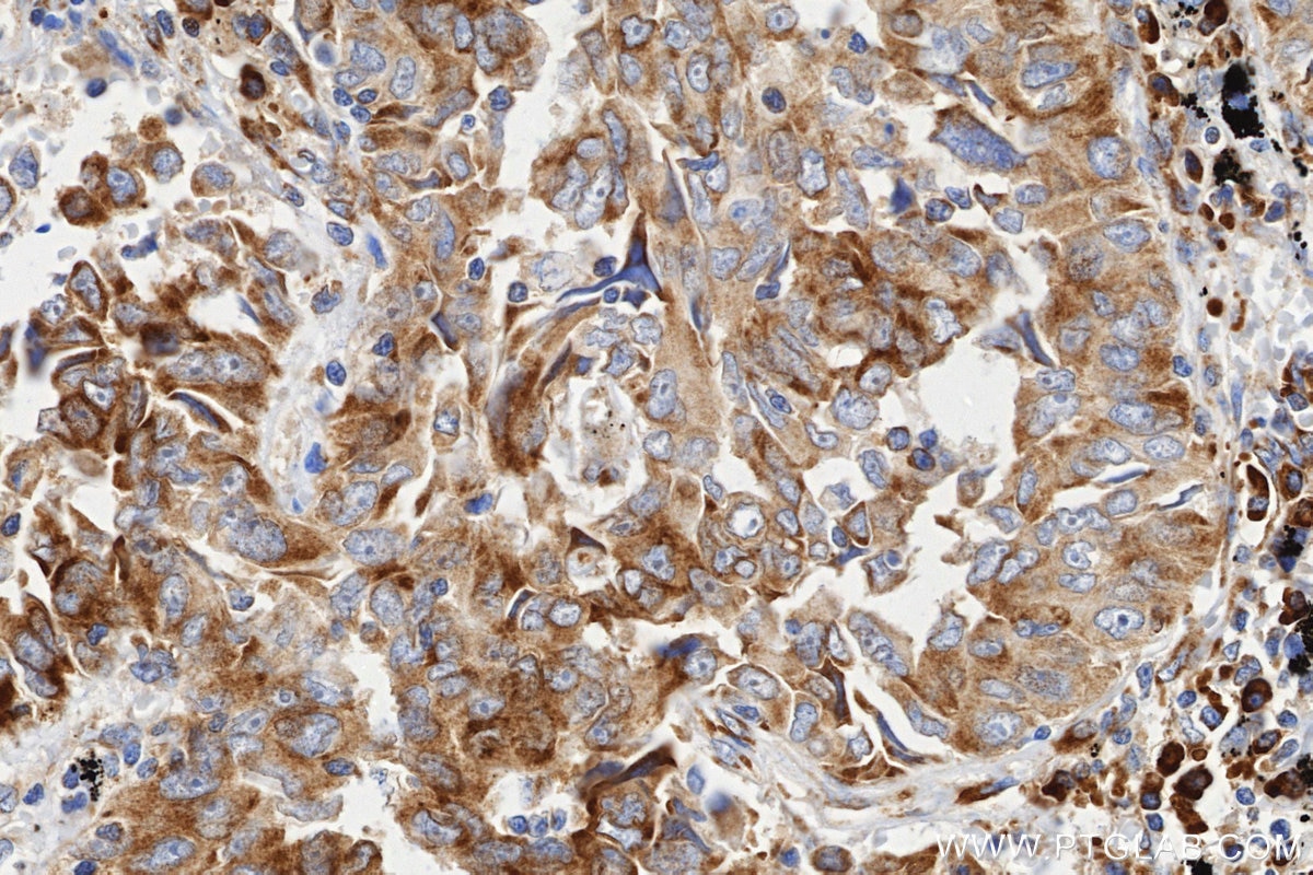 IHC staining of Human lung cancer (Adenocarcinoma) using 86254-3-RR Immunohistochemistry (IHC) staining of Human lung cancer (Adenocarcinoma) using RPS3A Recombinant monoclonal antibody (86254-3-RR)