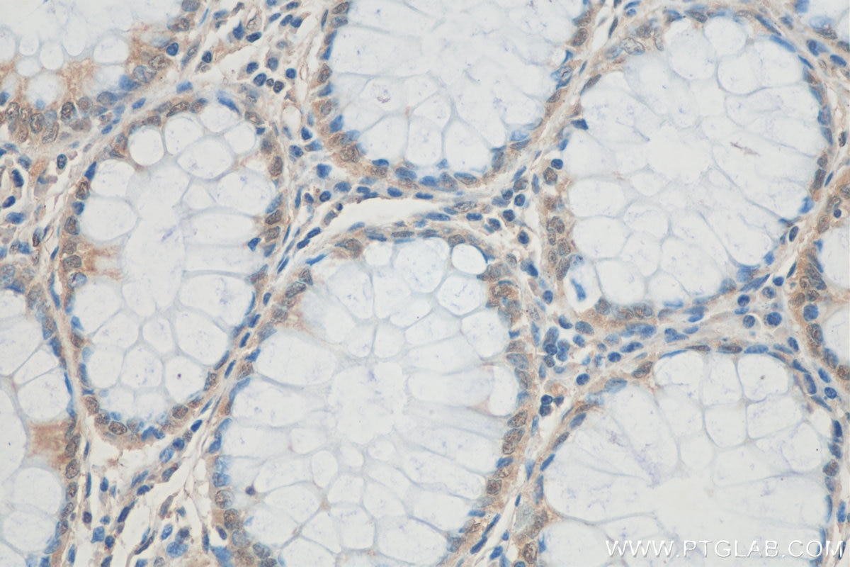 Immunohistochemistry (IHC) staining of human colon cancer tissue using S6 Ribosomal protein Polyclonal antibody (14823-1-AP)