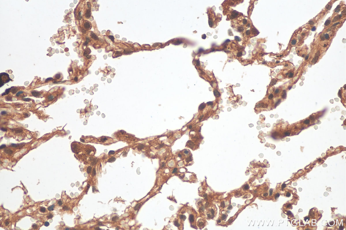 Immunohistochemistry (IHC) staining of human lung cancer tissue using S6 ribosomal protein Polyclonal antibody (14823-1-AP)