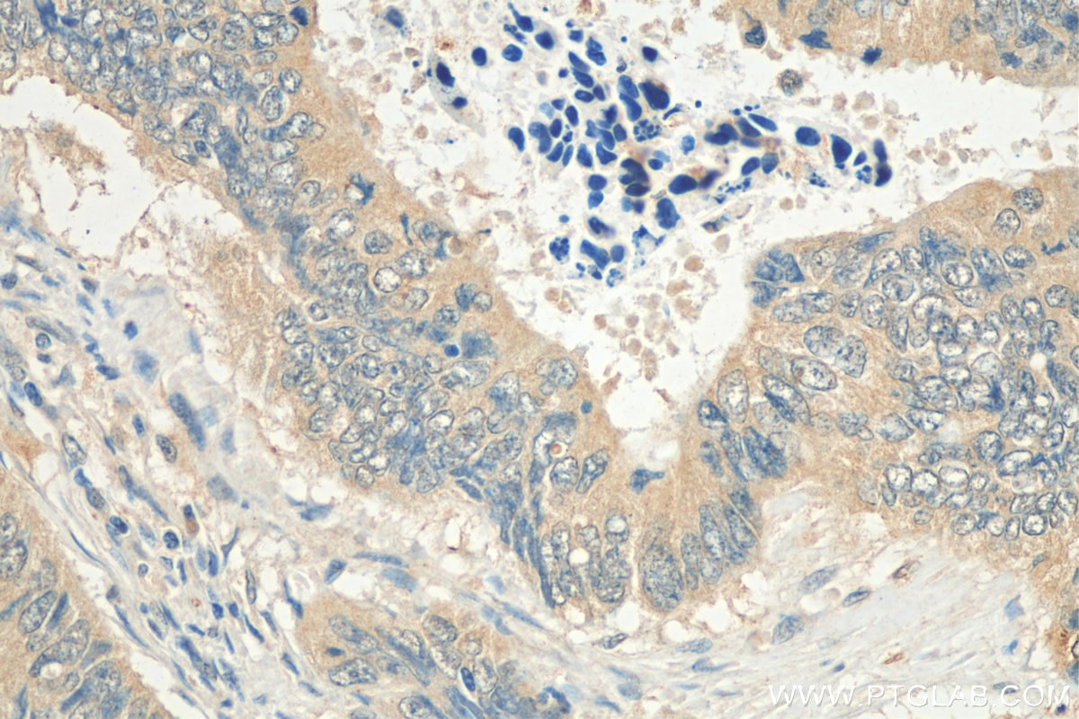 Immunohistochemistry (IHC) staining of human colon cancer tissue using S6 Ribosomal protein Polyclonal antibody (14823-1-AP)