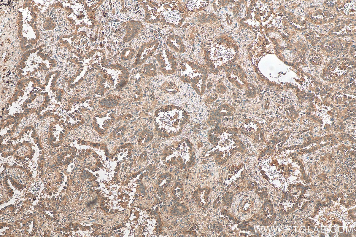 Immunohistochemistry (IHC) staining of human lung cancer tissue using S6 Ribosomal protein Polyclonal antibody (14823-1-AP)
