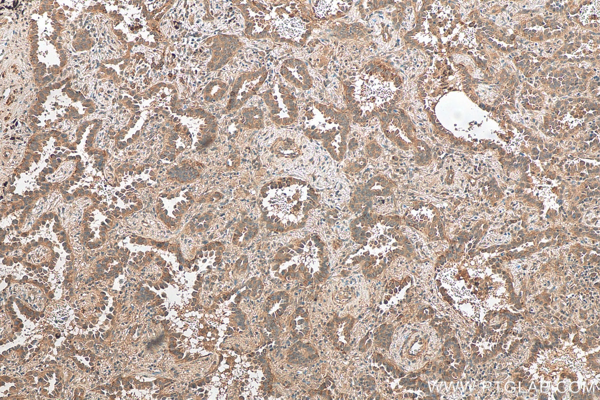 IHC staining of human lung cancer using 14823-1-AP