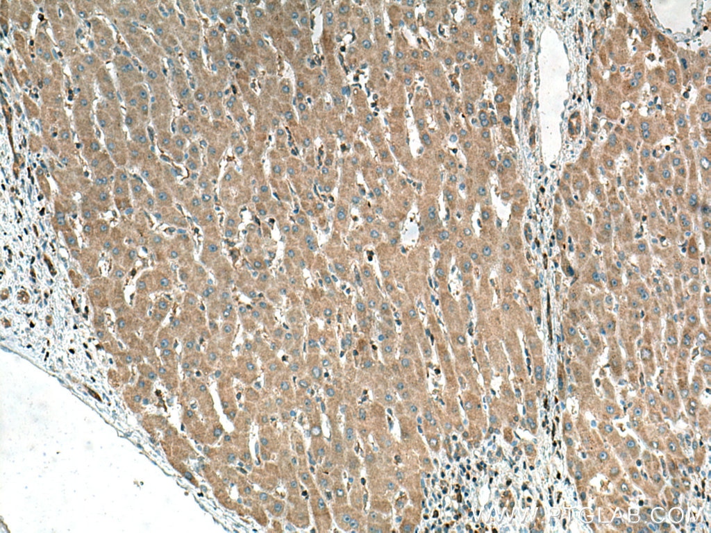 Immunohistochemistry (IHC) staining of human liver cancer tissue using RPS6KA1 Polyclonal antibody (16463-1-AP)