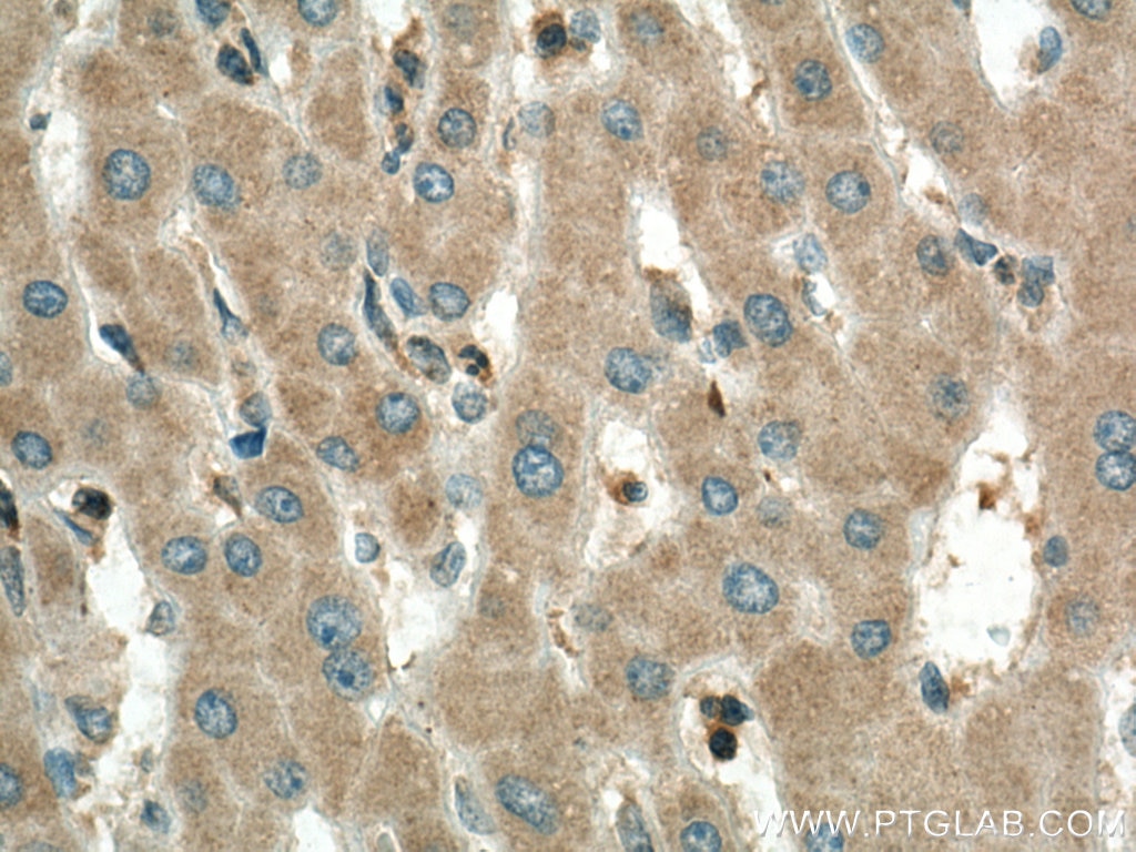 Immunohistochemistry (IHC) staining of human liver cancer tissue using RPS6KA1 Polyclonal antibody (16463-1-AP)