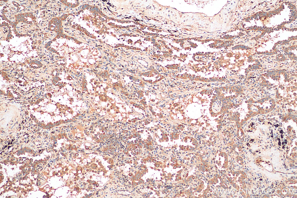 Immunohistochemistry (IHC) staining of human lung cancer tissue using RSK3 Polyclonal antibody (14446-1-AP)