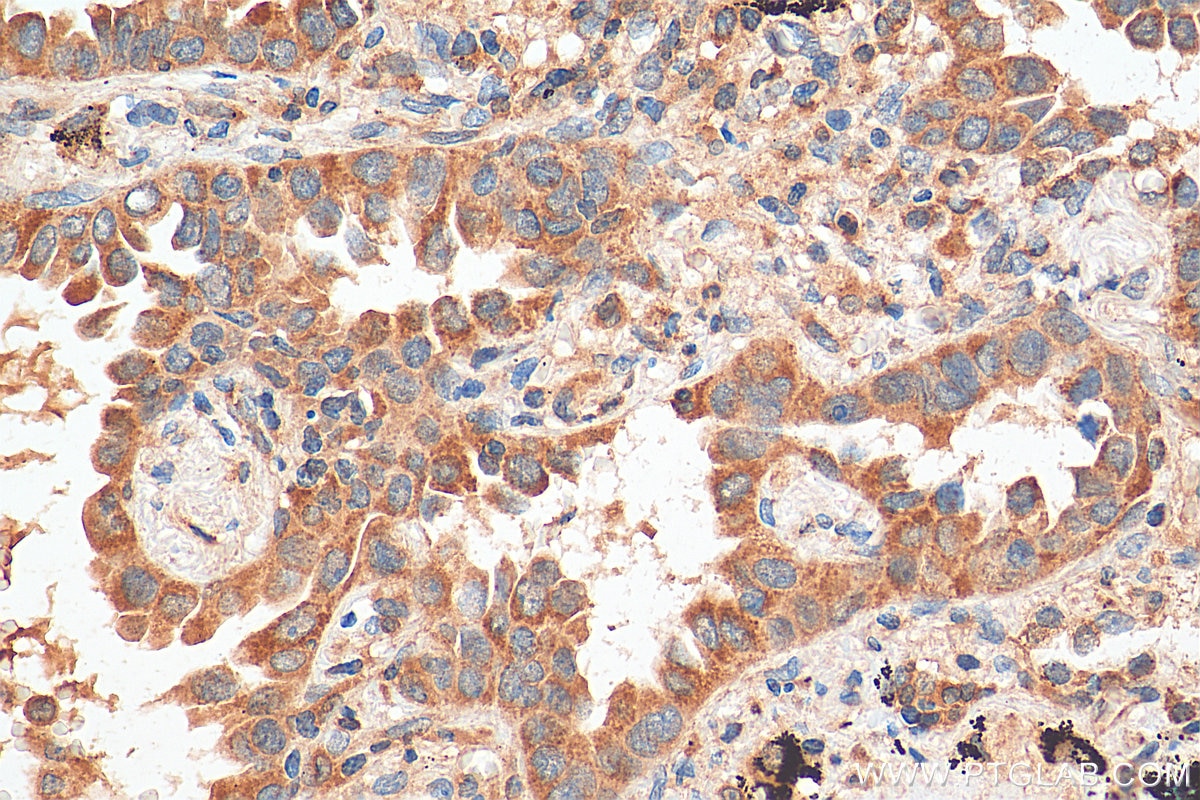 Immunohistochemistry (IHC) staining of human lung cancer tissue using RSK3 Polyclonal antibody (14446-1-AP)
