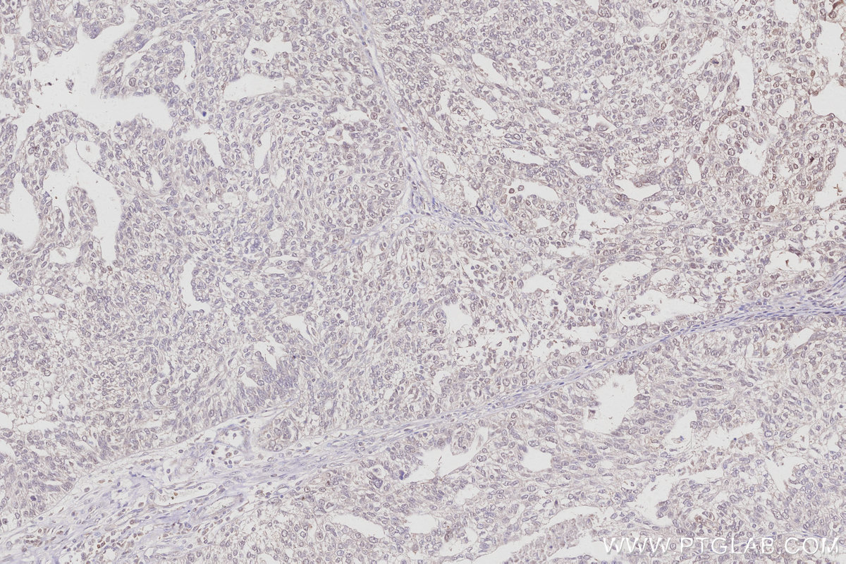 Immunohistochemistry (IHC) staining of human ovary cancer tissue using RPS6KB2 Polyclonal antibody (15268-1-AP)