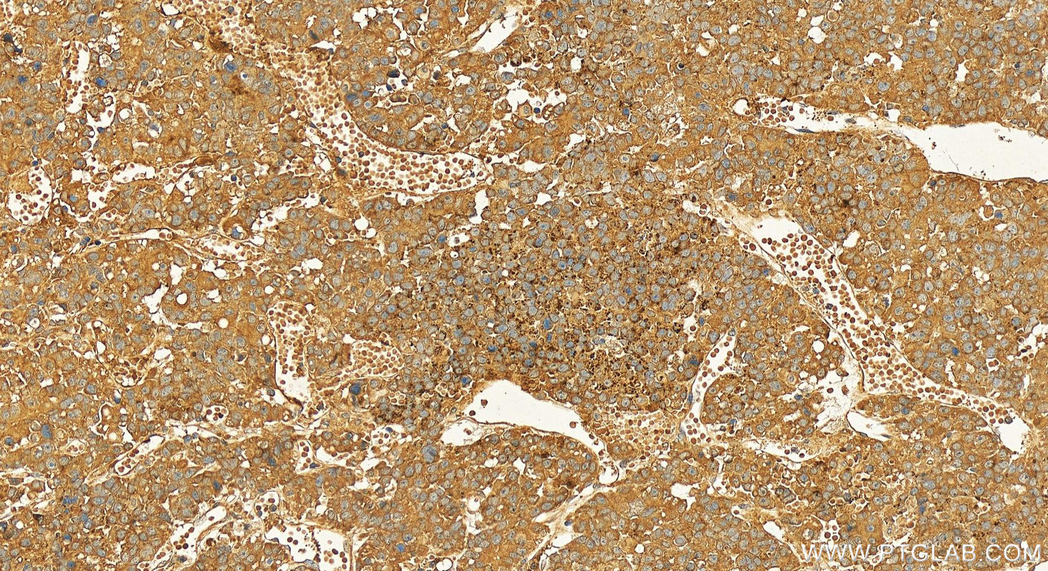 Immunohistochemical analysis of paraffin-embedded human hepatocellular carcinoma slide using 20984-1-AP (Raptor antibody) at dilution of 1:200 (under 20x lens). Heat mediated antigen retrieval with Tris-EDTA buffer (pH 9.0). Immunohistochemistry (IHC) staining of human hepatocellular carcinoma using Raptor Polyclonal antibody (20984-1-AP)