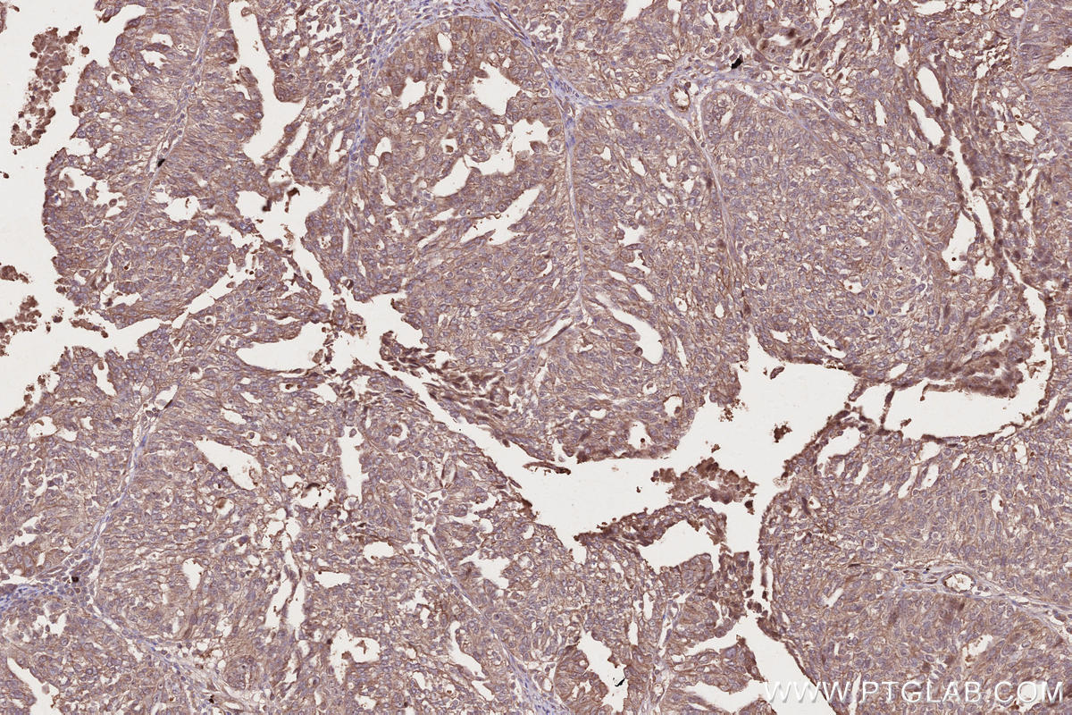 Immunohistochemistry (IHC) staining of human ovary cancer tissue using Raptor Polyclonal antibody (20984-1-AP)