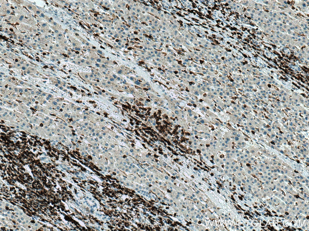 IHC staining of human liver cancer using 20103-1-AP