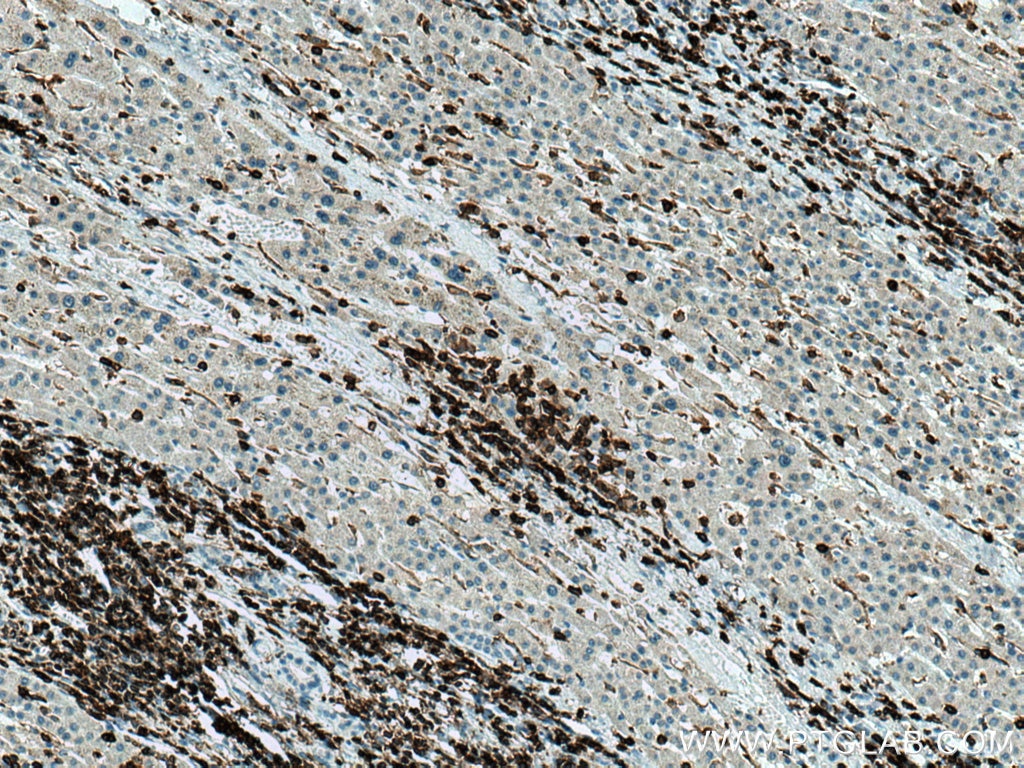 Immunohistochemistry (IHC) staining of human liver cancer tissue using CD45 Polyclonal antibody (20103-1-AP)