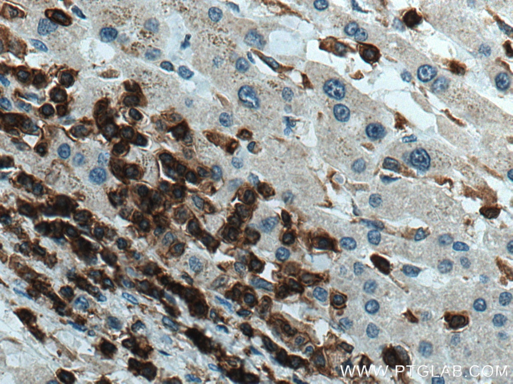 Immunohistochemistry (IHC) staining of human liver cancer tissue using CD45 Polyclonal antibody (20103-1-AP)