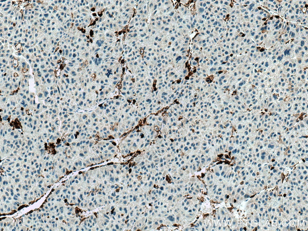 Immunohistochemistry (IHC) staining of human liver cancer tissue using CD45 Polyclonal antibody (20103-1-AP)