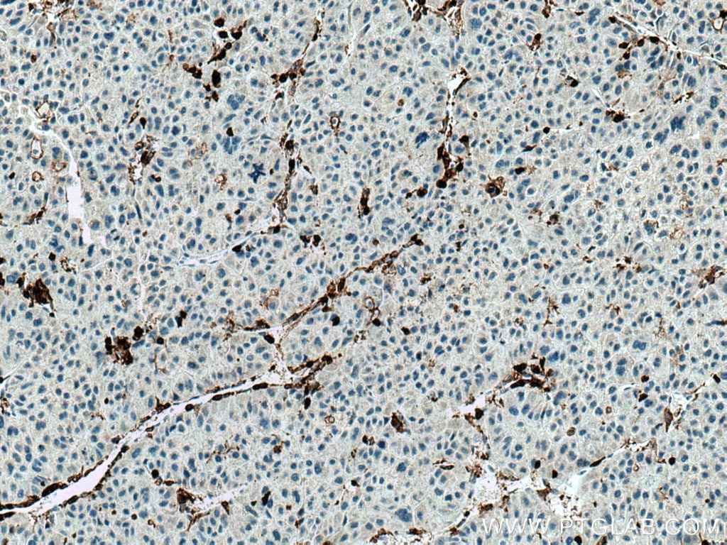 IHC staining of human liver cancer using 20103-1-AP