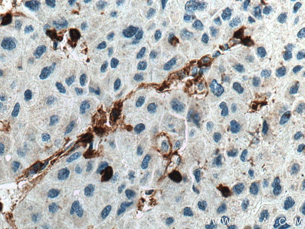 Immunohistochemistry (IHC) staining of human liver cancer tissue using CD45 Polyclonal antibody (20103-1-AP)