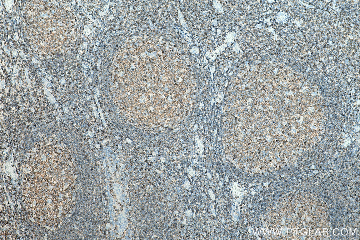 Immunohistochemistry (IHC) staining of human tonsillitis tissue using CD45 Polyclonal antibody (20103-1-AP)