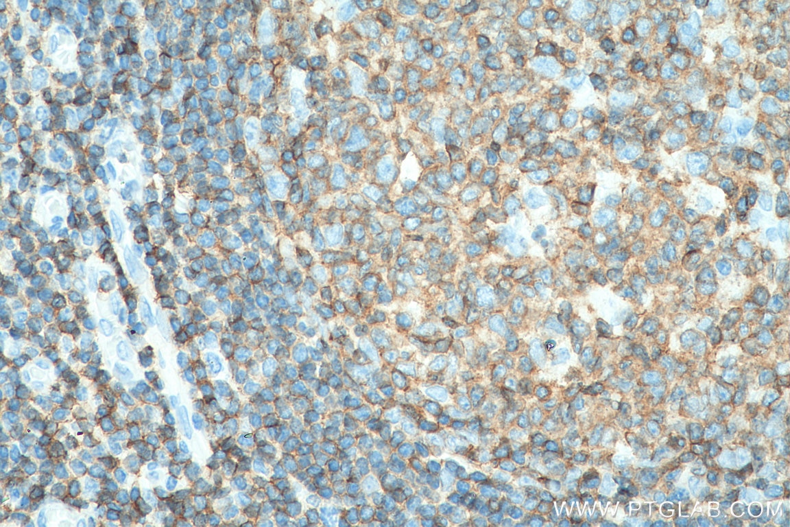 Immunohistochemistry (IHC) staining of human tonsillitis tissue using CD45 Polyclonal antibody (20103-1-AP)