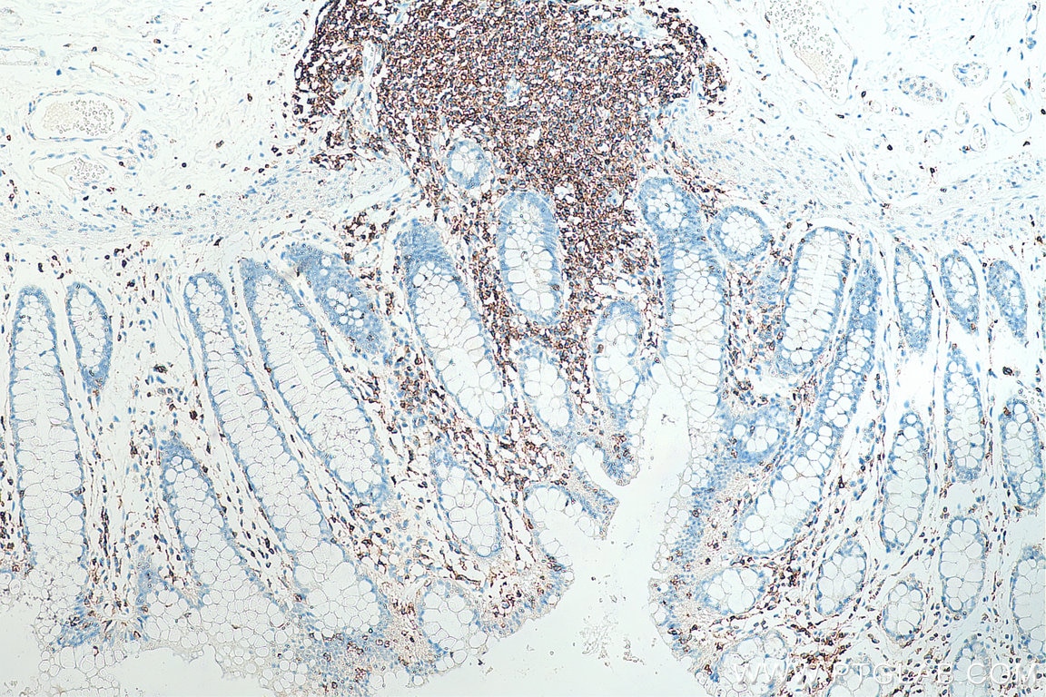 Immunohistochemistry (IHC) staining of human colon tissue using CD45 Polyclonal antibody (20103-1-AP)