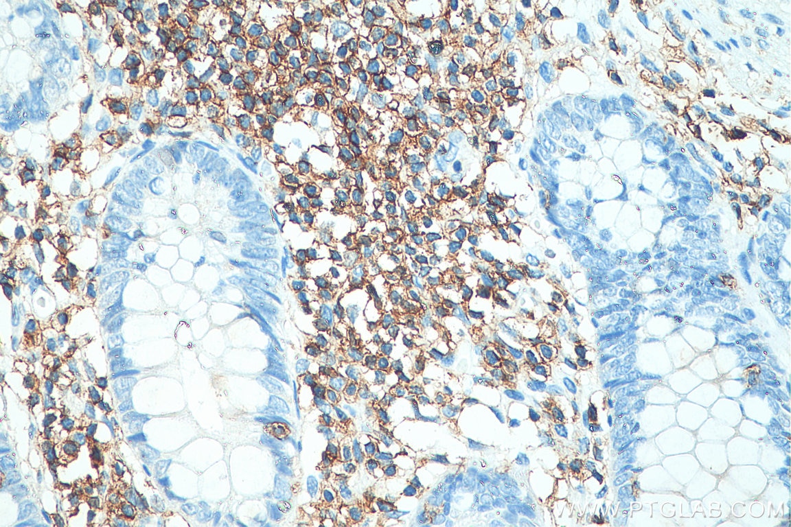Immunohistochemistry (IHC) staining of human colon tissue using CD45 Polyclonal antibody (20103-1-AP)