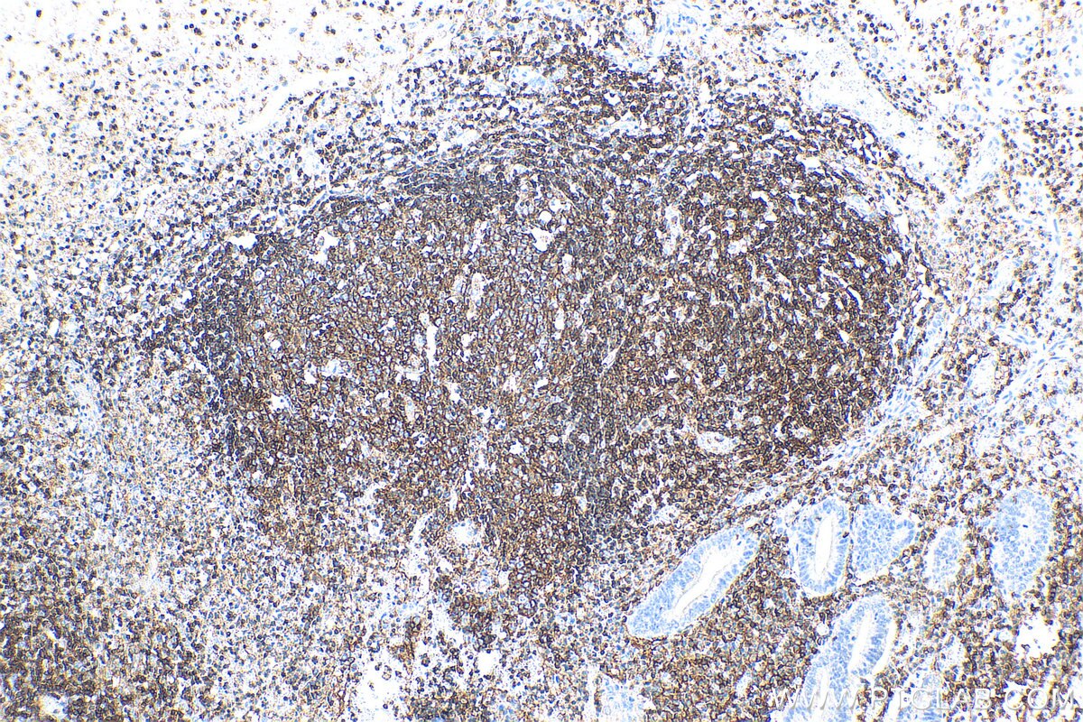 Immunohistochemistry (IHC) staining of human appendicitis tissue using CD45 Polyclonal antibody (20103-1-AP)