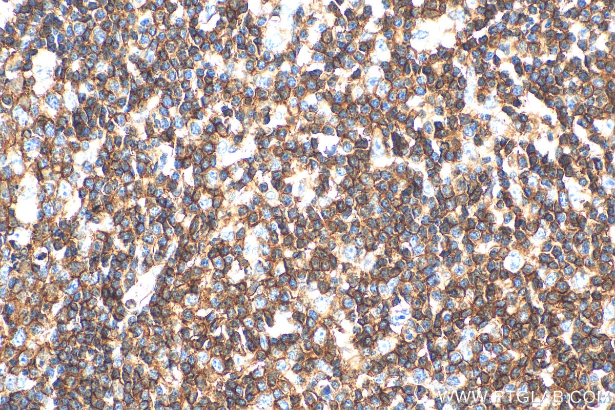 Immunohistochemistry (IHC) staining of human appendicitis tissue using CD45 Polyclonal antibody (20103-1-AP)