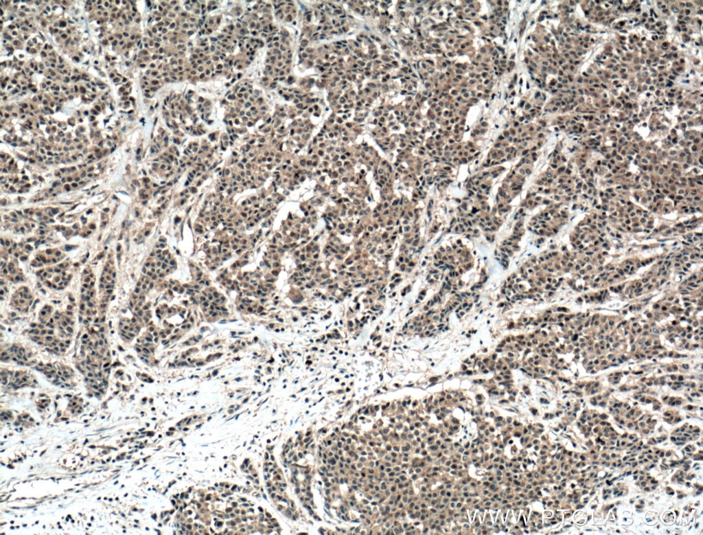 Immunohistochemistry (IHC) staining of human colon cancer tissue using RPUSD2 Polyclonal antibody (25707-1-AP)