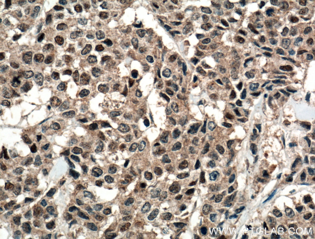 Immunohistochemistry (IHC) staining of human colon cancer tissue using RPUSD2 Polyclonal antibody (25707-1-AP)