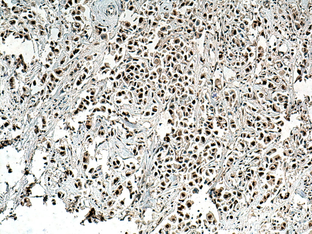 Immunohistochemistry (IHC) staining of human breast cancer tissue using RPUSD2 Polyclonal antibody (25707-1-AP)