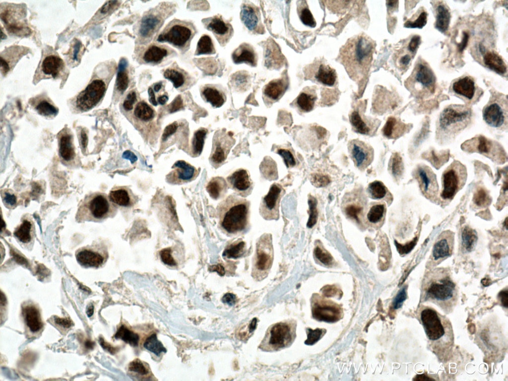 Immunohistochemistry (IHC) staining of human breast cancer tissue using RPUSD2 Polyclonal antibody (25707-1-AP)