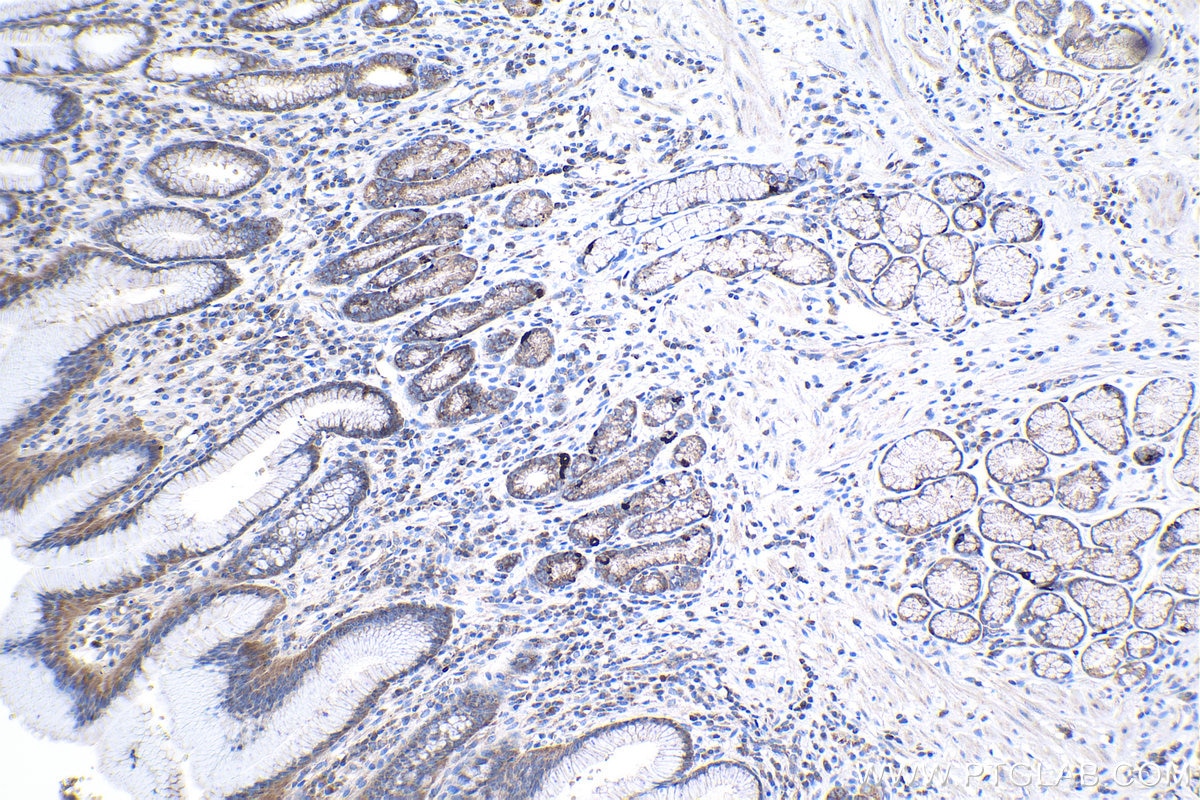 Immunohistochemistry (IHC) staining of human stomach cancer tissue using CNOT9 Polyclonal antibody (22503-1-AP)