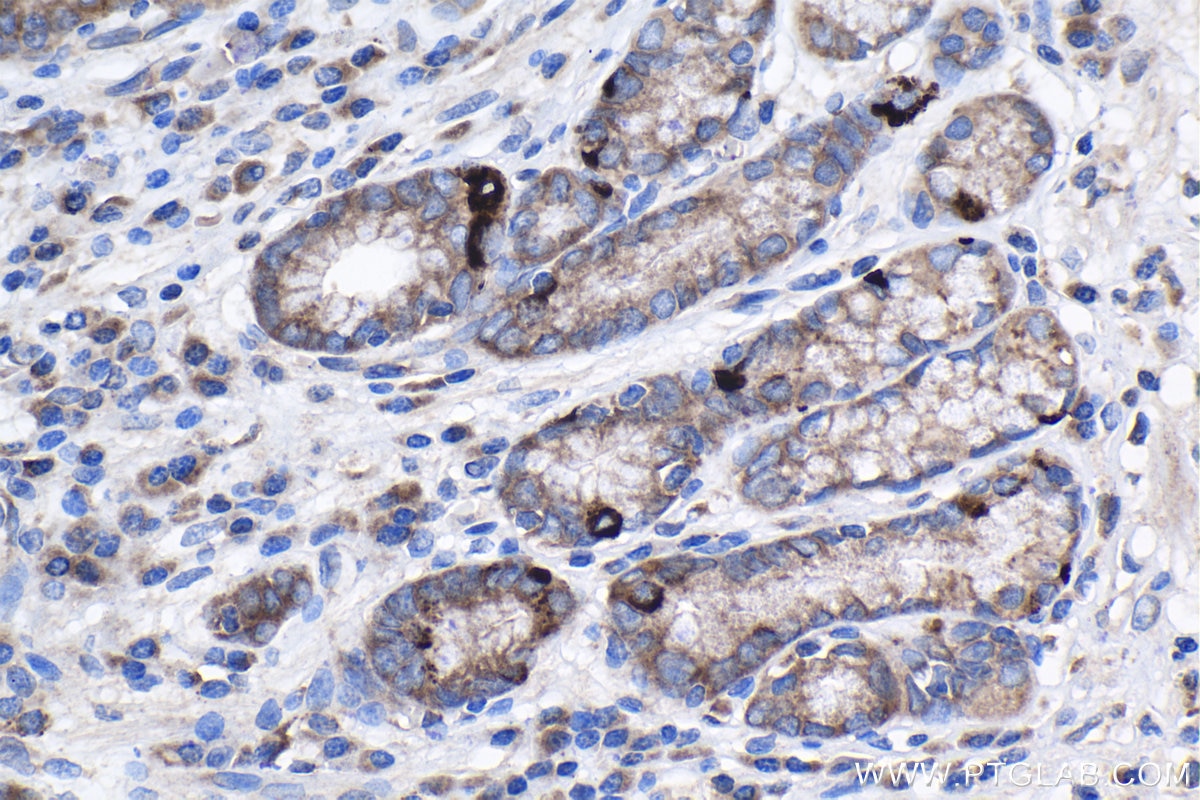 Immunohistochemistry (IHC) staining of human stomach cancer tissue using CNOT9 Polyclonal antibody (22503-1-AP)