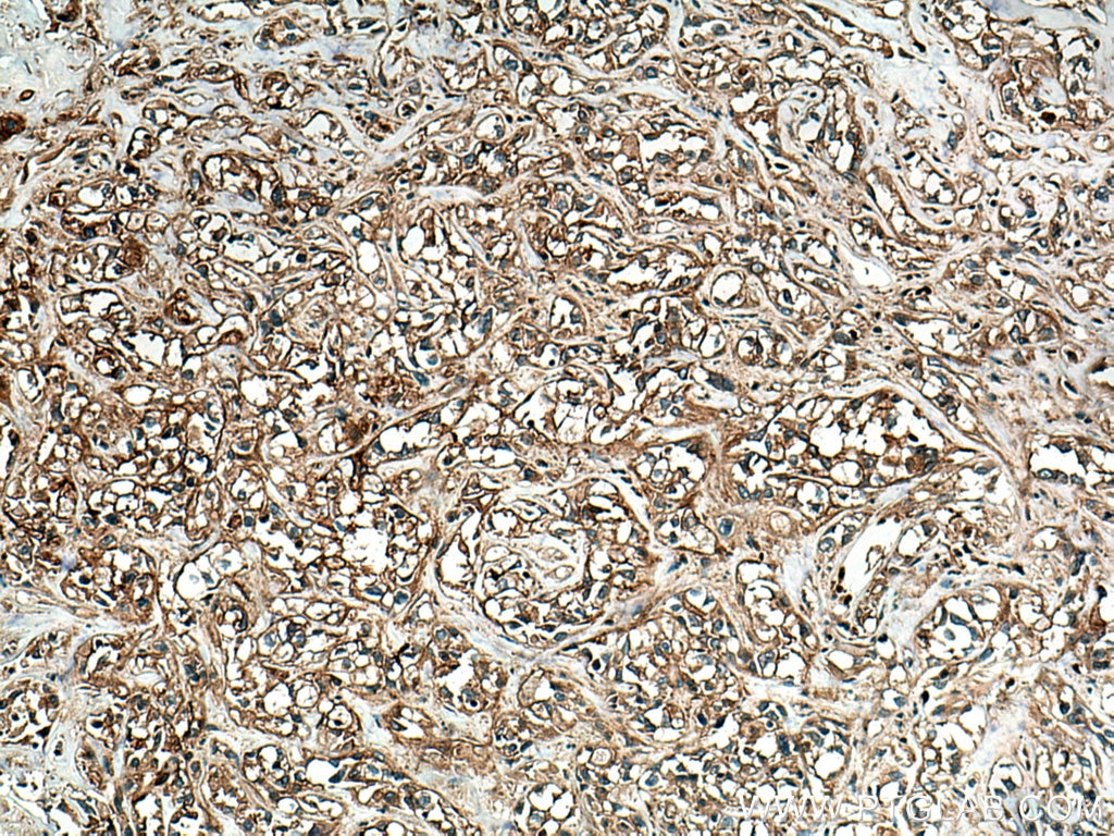 Immunohistochemistry (IHC) staining of human renal cell carcinoma tissue using RRAS Polyclonal antibody (27457-1-AP)