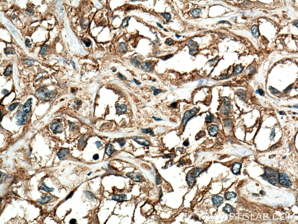 Immunohistochemistry (IHC) staining of human renal cell carcinoma tissue using RRAS Polyclonal antibody (27457-1-AP)