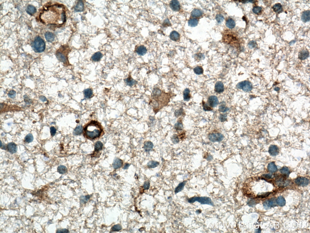 Immunohistochemistry (IHC) staining of human gliomas tissue using RRAS Polyclonal antibody (27457-1-AP)