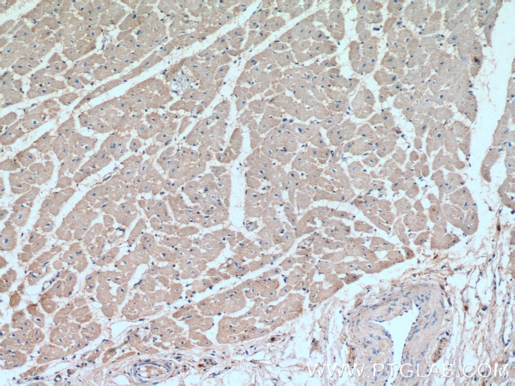 Immunohistochemistry (IHC) staining of human lung cancer tissue using RRAS2 Polyclonal antibody (12530-1-AP)