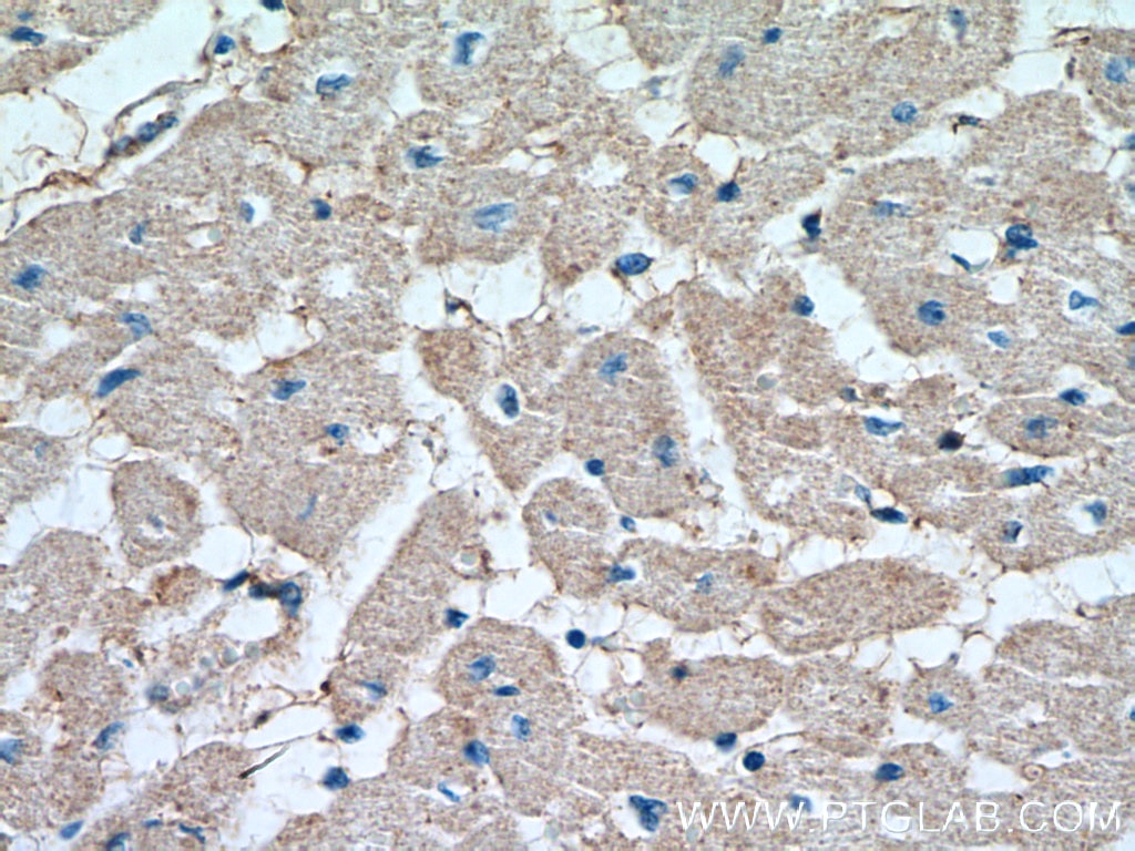 Immunohistochemistry (IHC) staining of human lung cancer tissue using RRAS2 Polyclonal antibody (12530-1-AP)