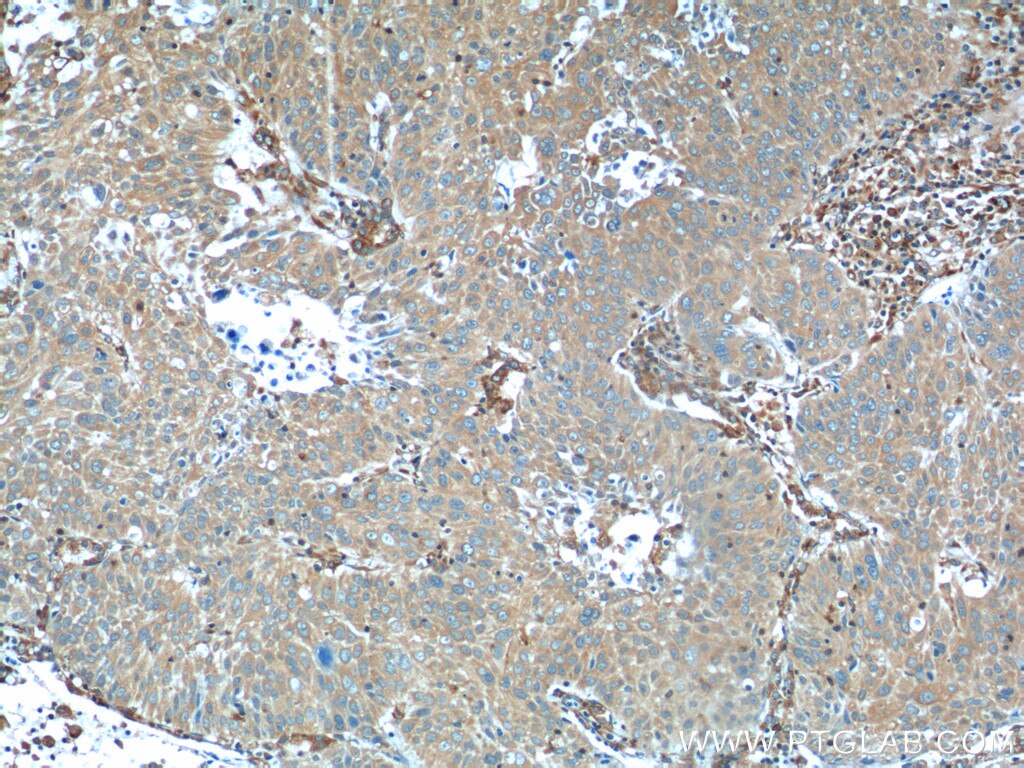 Immunohistochemistry (IHC) staining of human lung cancer tissue using RRBP1 Polyclonal antibody (22015-1-AP)