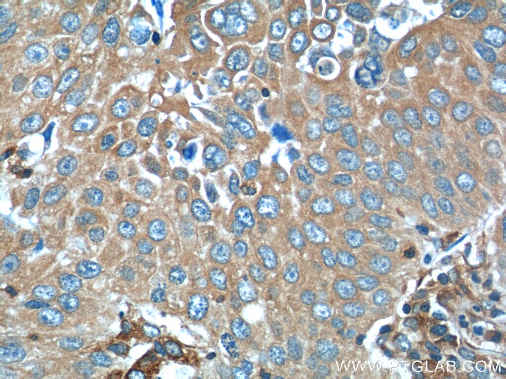 Immunohistochemistry (IHC) staining of human lung cancer tissue using RRBP1 Polyclonal antibody (22015-1-AP)